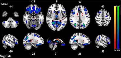 Cognitive Implications of Correlated Structural Network Changes in Schizophrenia